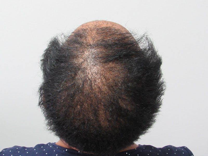 PRP Hair Restoration Before & After Gallery - Patient 741573 - Image 3