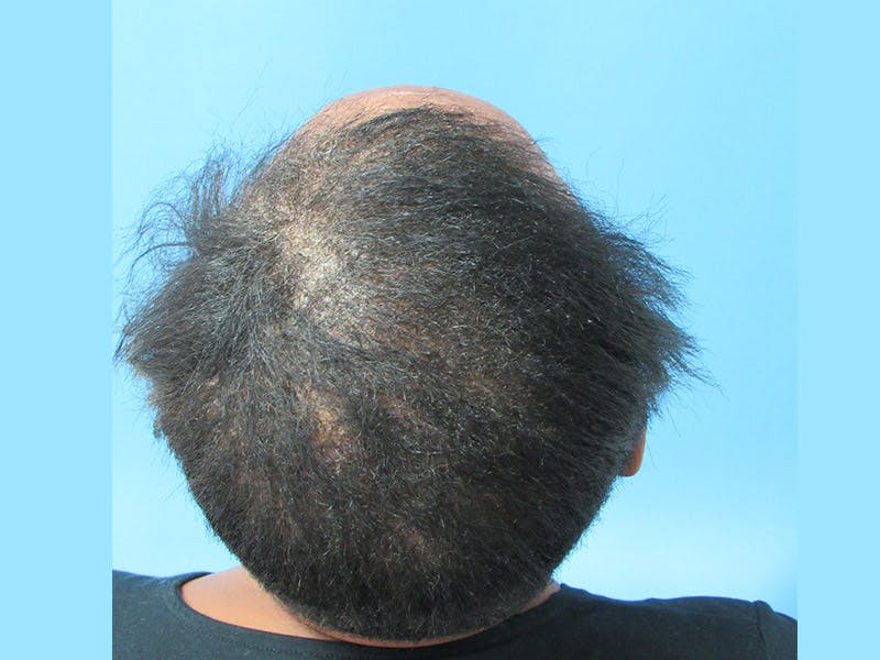 PRP Hair Restoration Before & After Gallery - Patient 741573 - Image 4