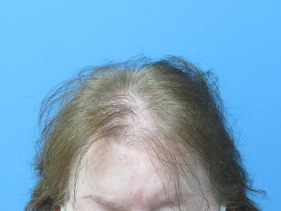 PRP Hair Restoration Before & After Gallery - Patient 216436 - Image 1