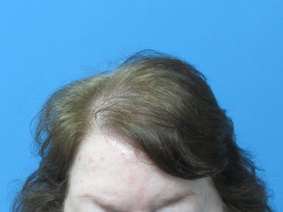 PRP Hair Restoration Before & After Gallery - Patient 216436 - Image 2