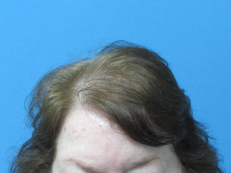 PRP Hair Restoration Before & After Gallery - Patient 216436 - Image 2