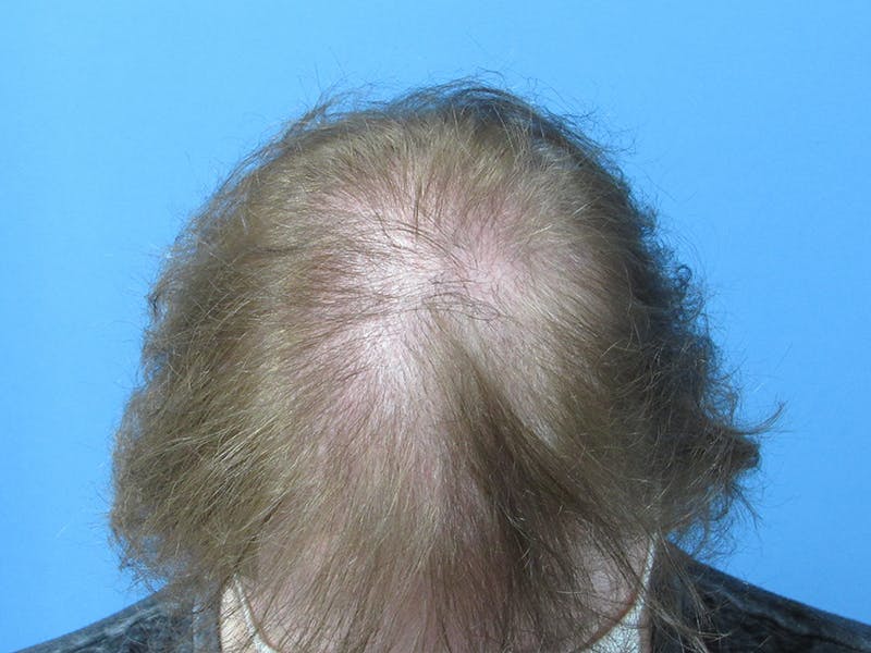 PRP Hair Restoration Before & After Gallery - Patient 216436 - Image 3