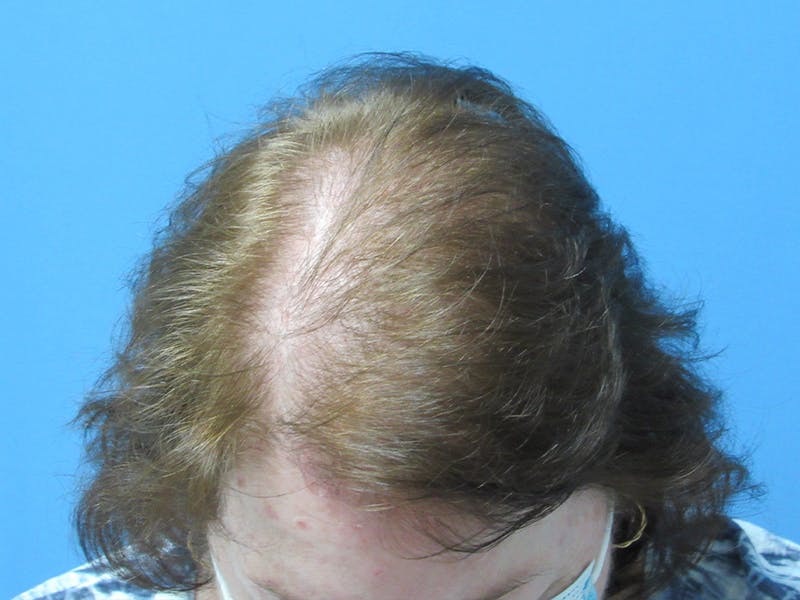 PRP Hair Restoration Before & After Gallery - Patient 216436 - Image 4