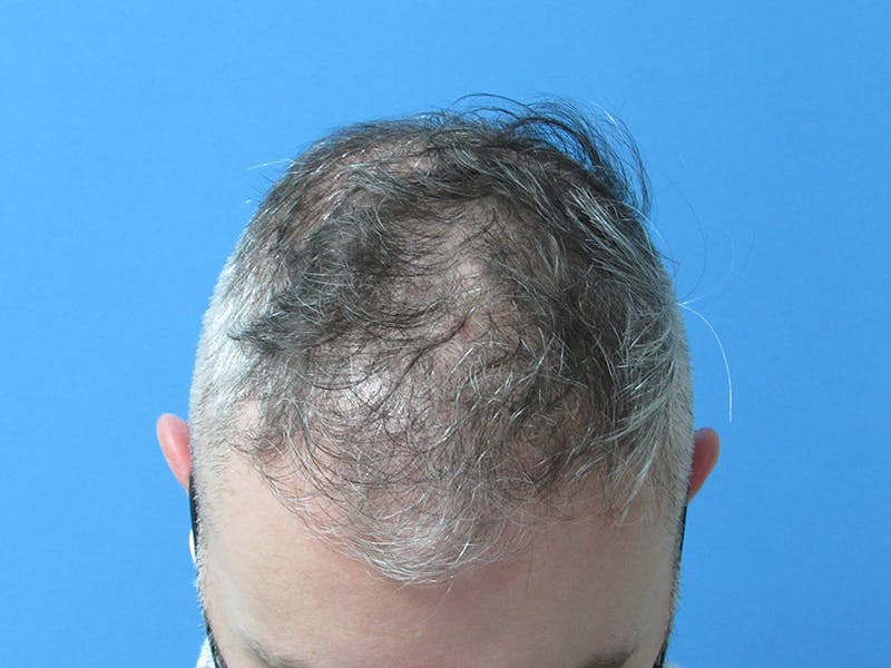 hair restoration patient