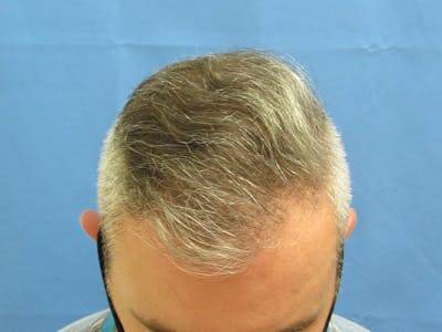 hair restoration patient