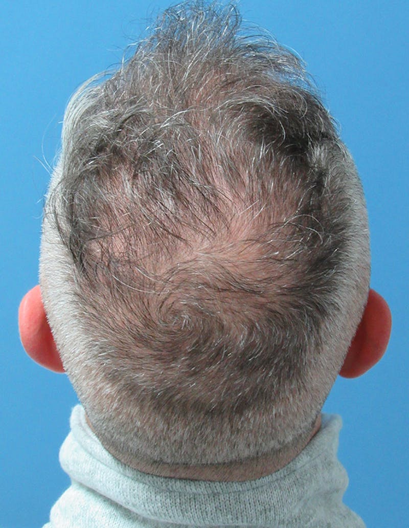 PRP Hair Restoration Before & After Gallery - Patient 352940 - Image 3