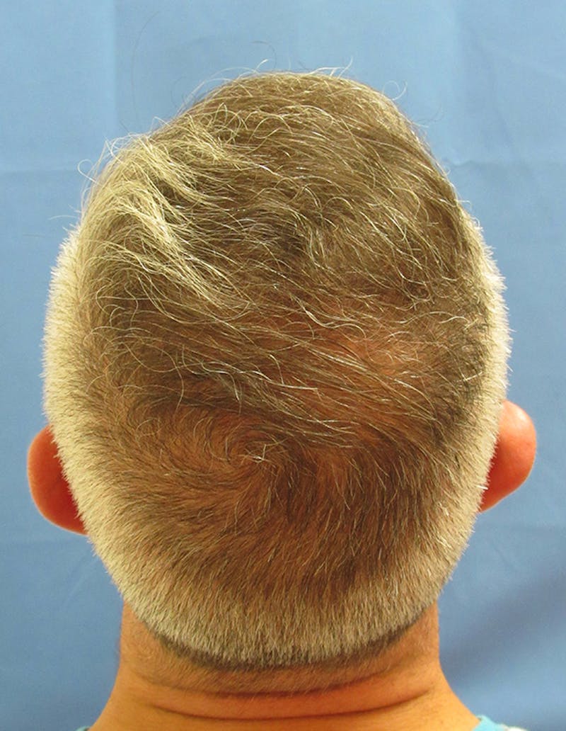PRP Hair Restoration Before & After Gallery - Patient 352940 - Image 4