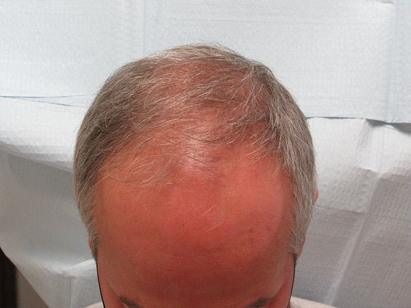 PRP Hair Restoration Before & After Gallery - Patient 751365 - Image 1