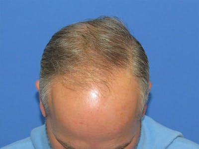 PRP Hair Restoration Before & After Gallery - Patient 751365 - Image 2