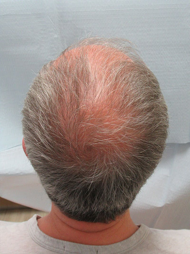 PRP Hair Restoration Before & After Gallery - Patient 751365 - Image 3