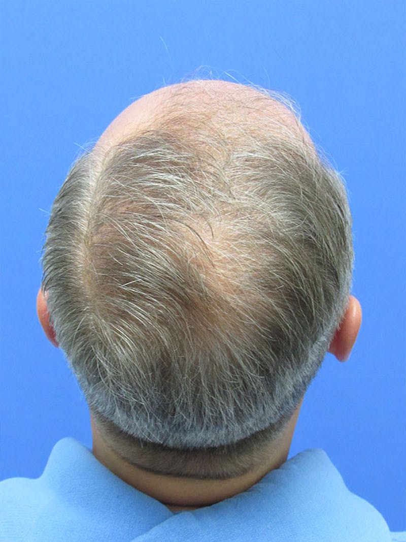 PRP Hair Restoration Before & After Gallery - Patient 751365 - Image 4
