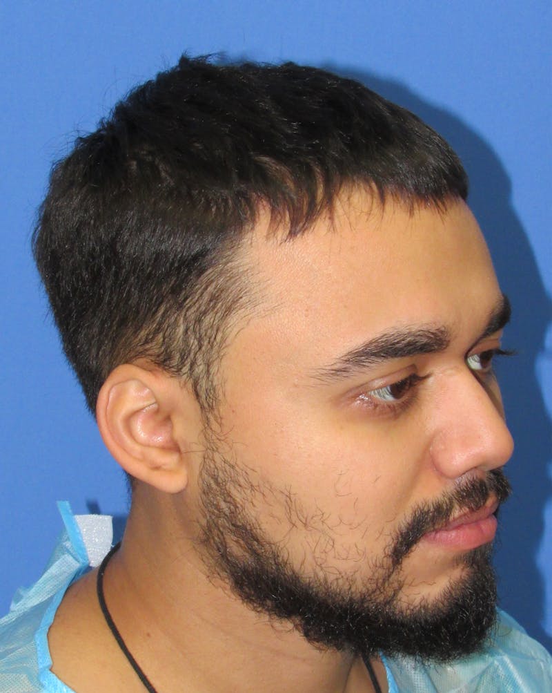 Facial Hair Transplant Before & After Gallery - Patient 149851 - Image 3