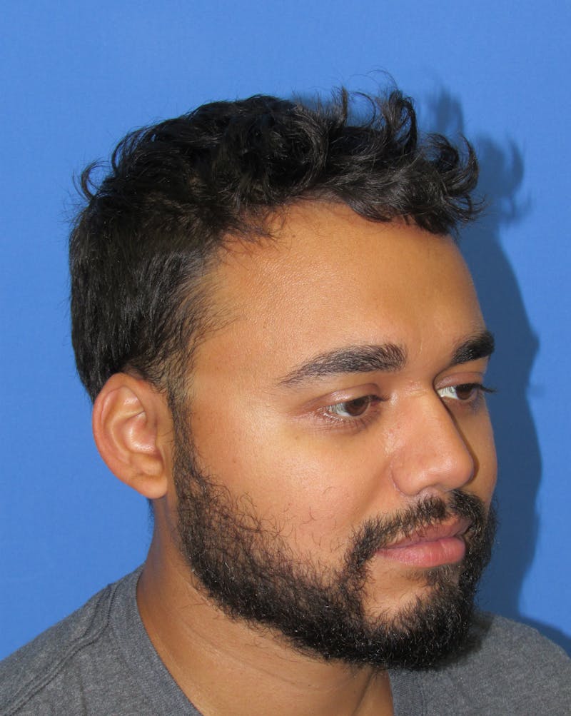 Facial Hair Transplant Before & After Gallery - Patient 149851 - Image 4