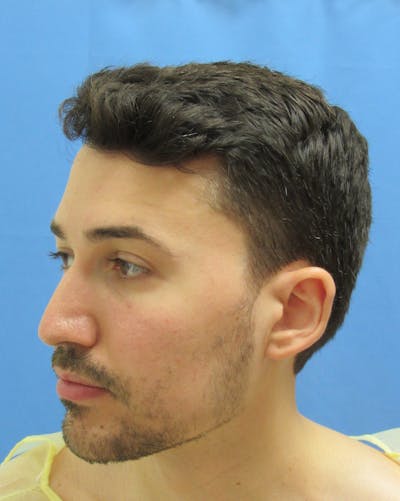 Facial Hair Transplant Before & After Gallery - Patient 359115 - Image 1
