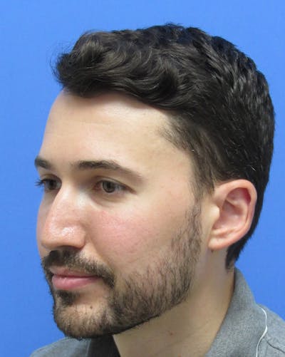 Facial Hair Transplant Before & After Gallery - Patient 359115 - Image 2