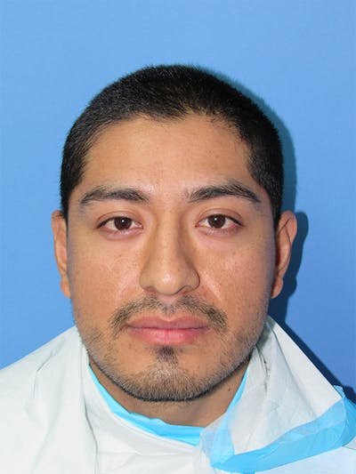 Facial Hair Transplant Before & After Gallery - Patient 175860 - Image 1