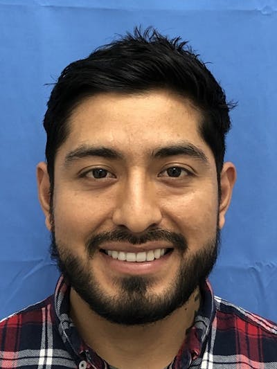Facial Hair Transplant Before & After Gallery - Patient 175860 - Image 2