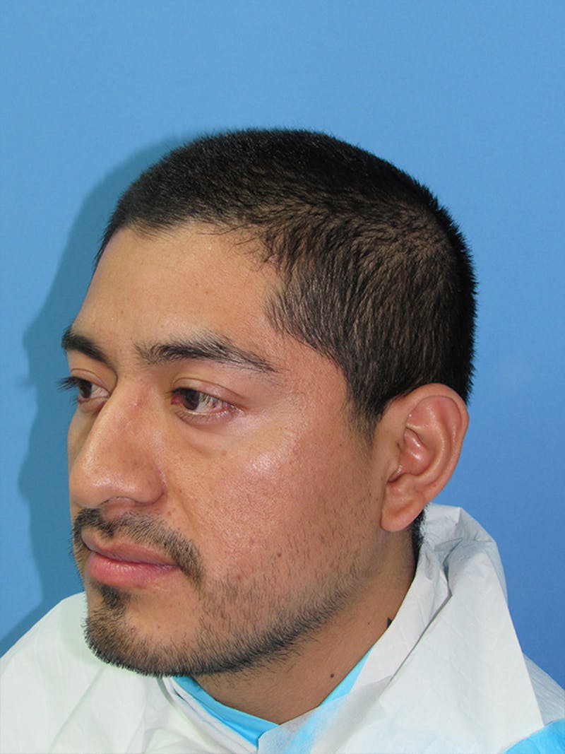 Facial Hair Transplant Before & After Gallery - Patient 175860 - Image 3