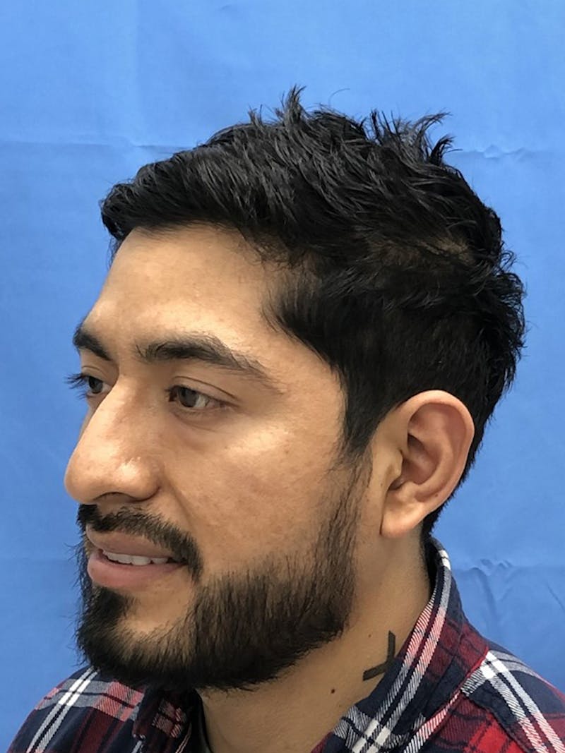 Facial Hair Transplant Before & After Gallery - Patient 175860 - Image 4