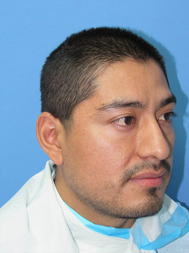 Facial Hair Transplant Before & After Gallery - Patient 175860 - Image 5