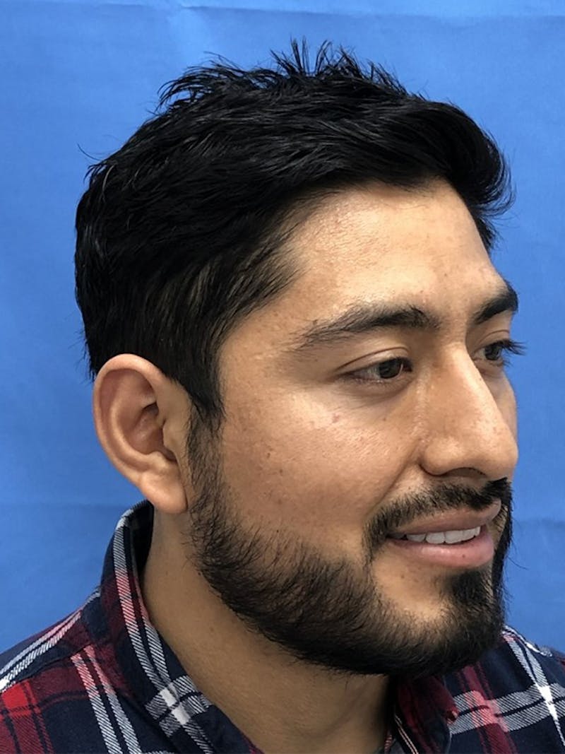 Facial Hair Transplant Before & After Gallery - Patient 175860 - Image 6