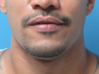 Facial Hair Transplant Before & After Gallery - Patient 241237 - Image 1