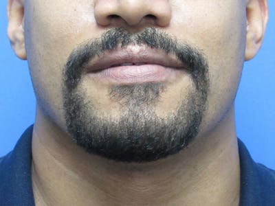 Facial Hair Transplant Before & After Gallery - Patient 241237 - Image 2