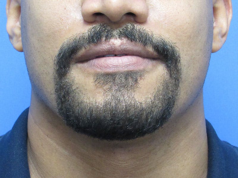 Facial Hair Transplant Before & After Gallery - Patient 241237 - Image 2
