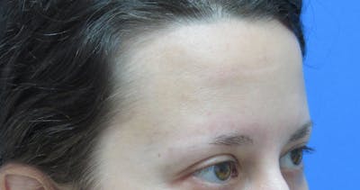 Eyebrow Transplant Before & After Gallery - Patient 961805 - Image 1