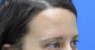 Eyebrow Transplant Before & After Gallery - Patient 961805 - Image 2
