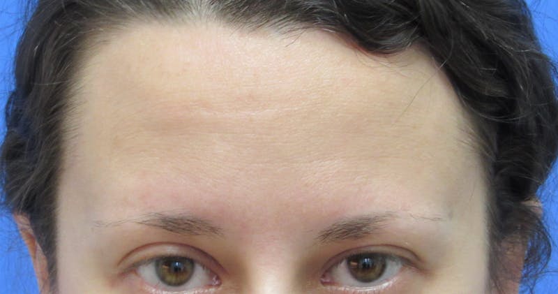 Eyebrow Transplant Before & After Gallery - Patient 961805 - Image 3
