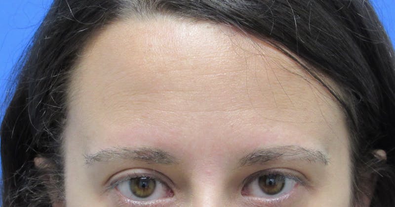Eyebrow Transplant Before & After Gallery - Patient 961805 - Image 4