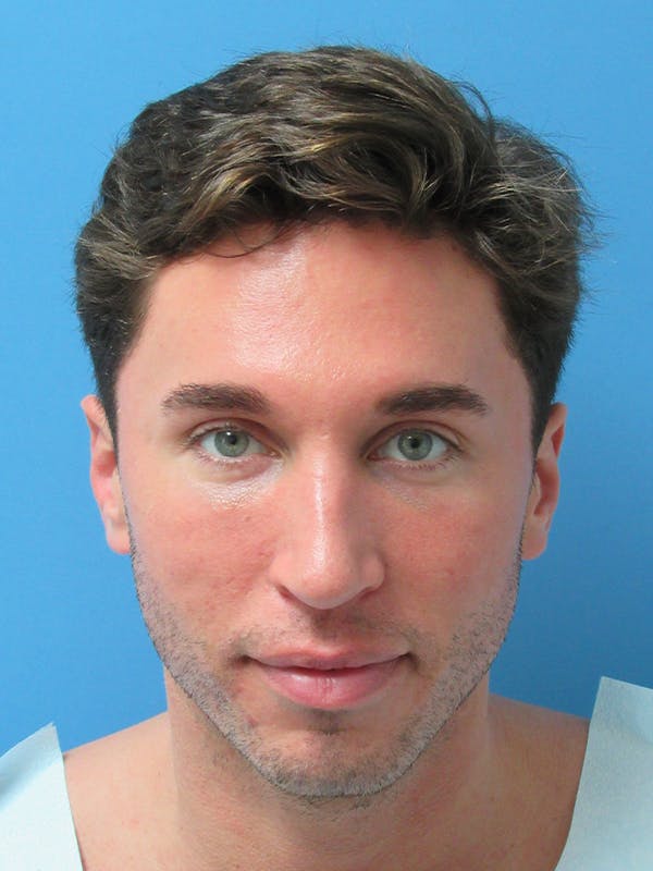 hair restoration patient