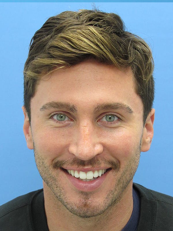 hair restoration patient