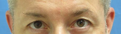 Eyebrow Transplant Before & After Gallery - Patient 155829 - Image 1