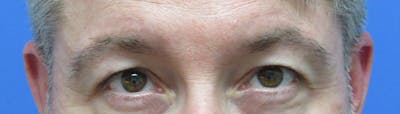 Eyebrow Transplant Before & After Gallery - Patient 155829 - Image 2