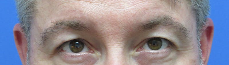 Eyebrow Transplant Before & After Gallery - Patient 155829 - Image 2
