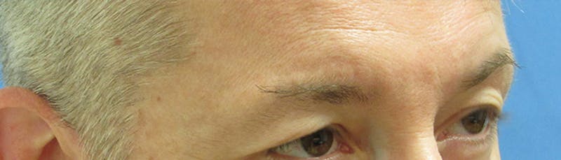 Eyebrow Transplant Before & After Gallery - Patient 155829 - Image 3