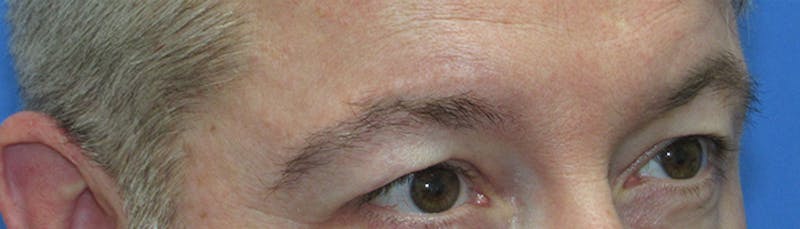 Eyebrow Transplant Before & After Gallery - Patient 155829 - Image 4
