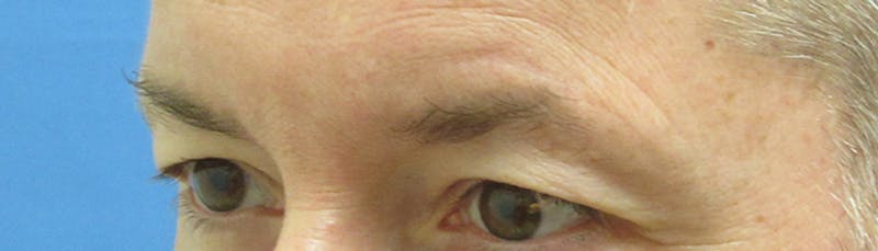 Eyebrow Transplant Before & After Gallery - Patient 155829 - Image 5