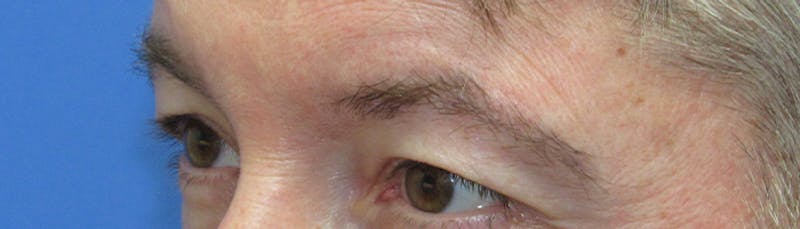 Eyebrow Transplant Before & After Gallery - Patient 155829 - Image 6