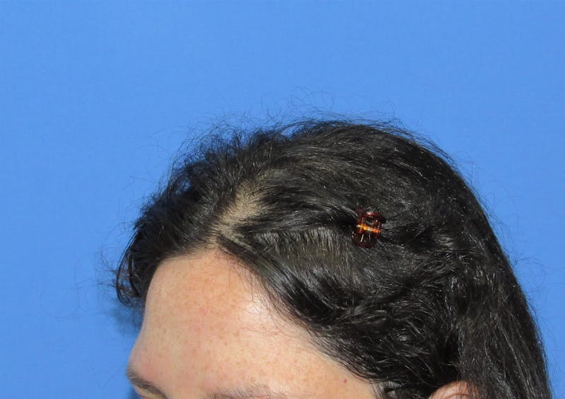 Female Hair Transplant Before & After Gallery - Patient 156476 - Image 4