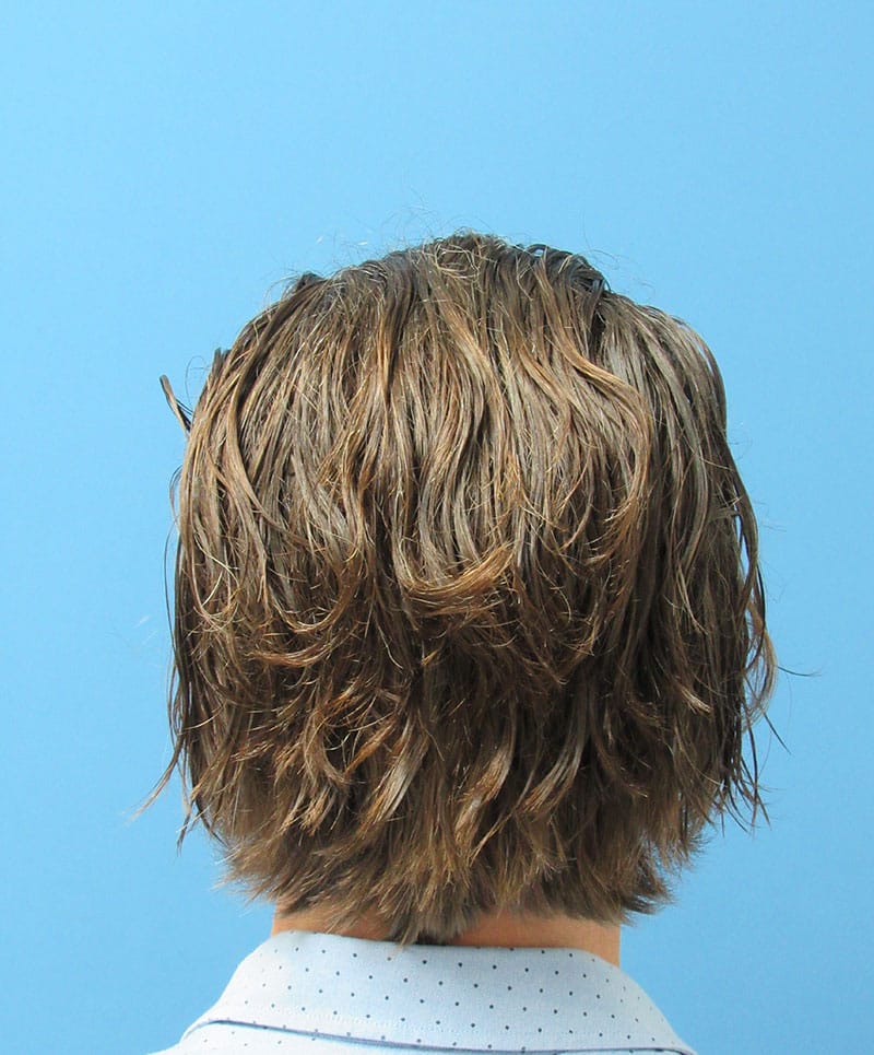 hair restoration patient