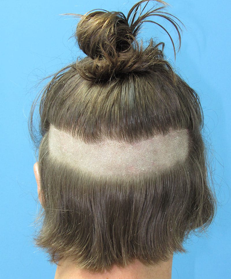 hair restoration patient