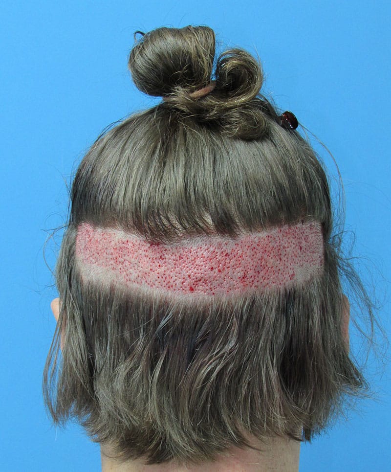 hair restoration patient