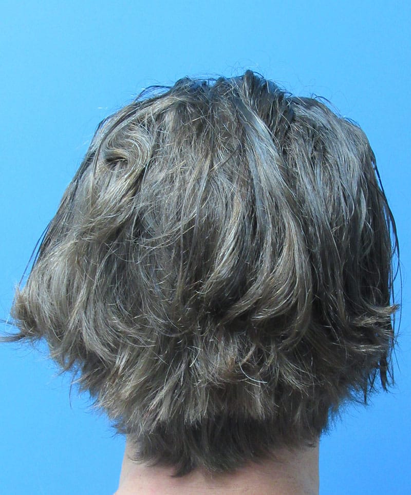 hair restoration patient