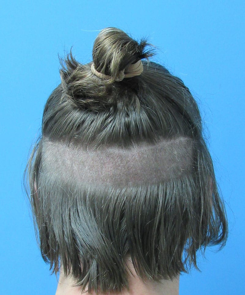 hair restoration patient