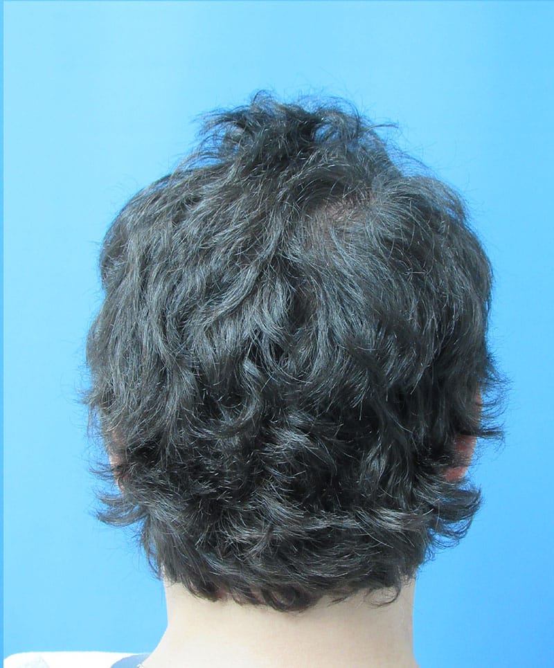 hair restoration patient
