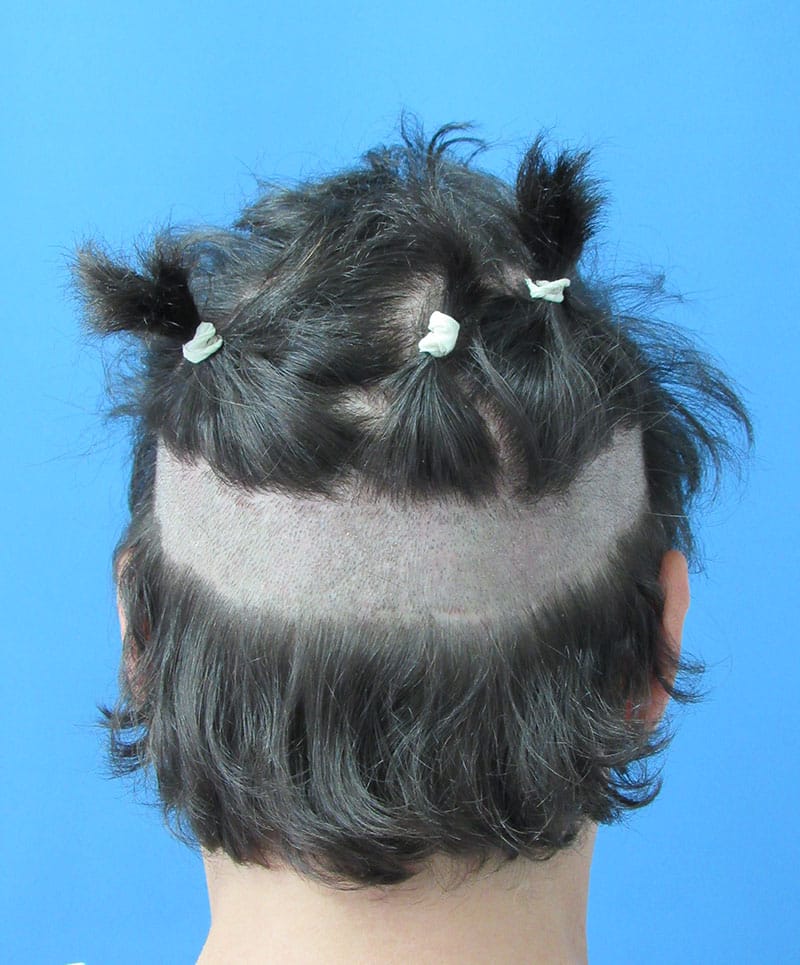 hair restoration patient