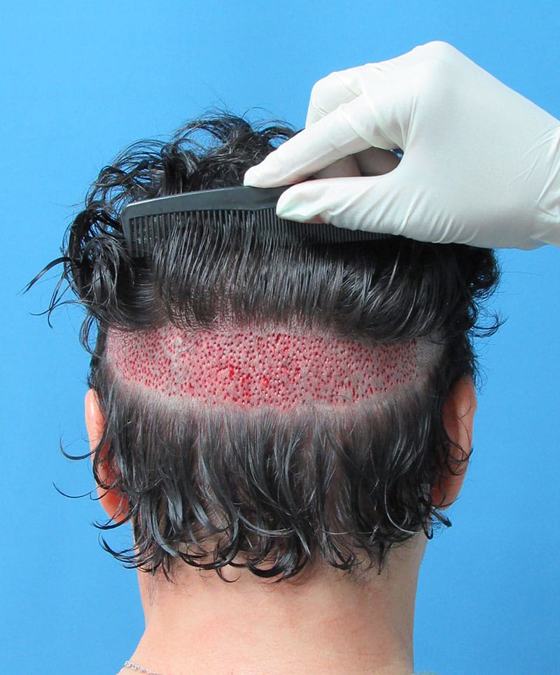 hair restoration patient